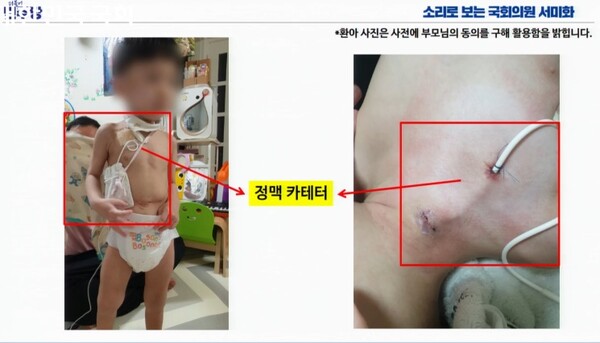 매일 저녁 8시부터 아침 7시까지 하루 평균 12시간을 가슴에 삽입된 카테터로 TPN을 평생 공급받아야 살 수 있는 아동의 모습.ⓒ국회방송